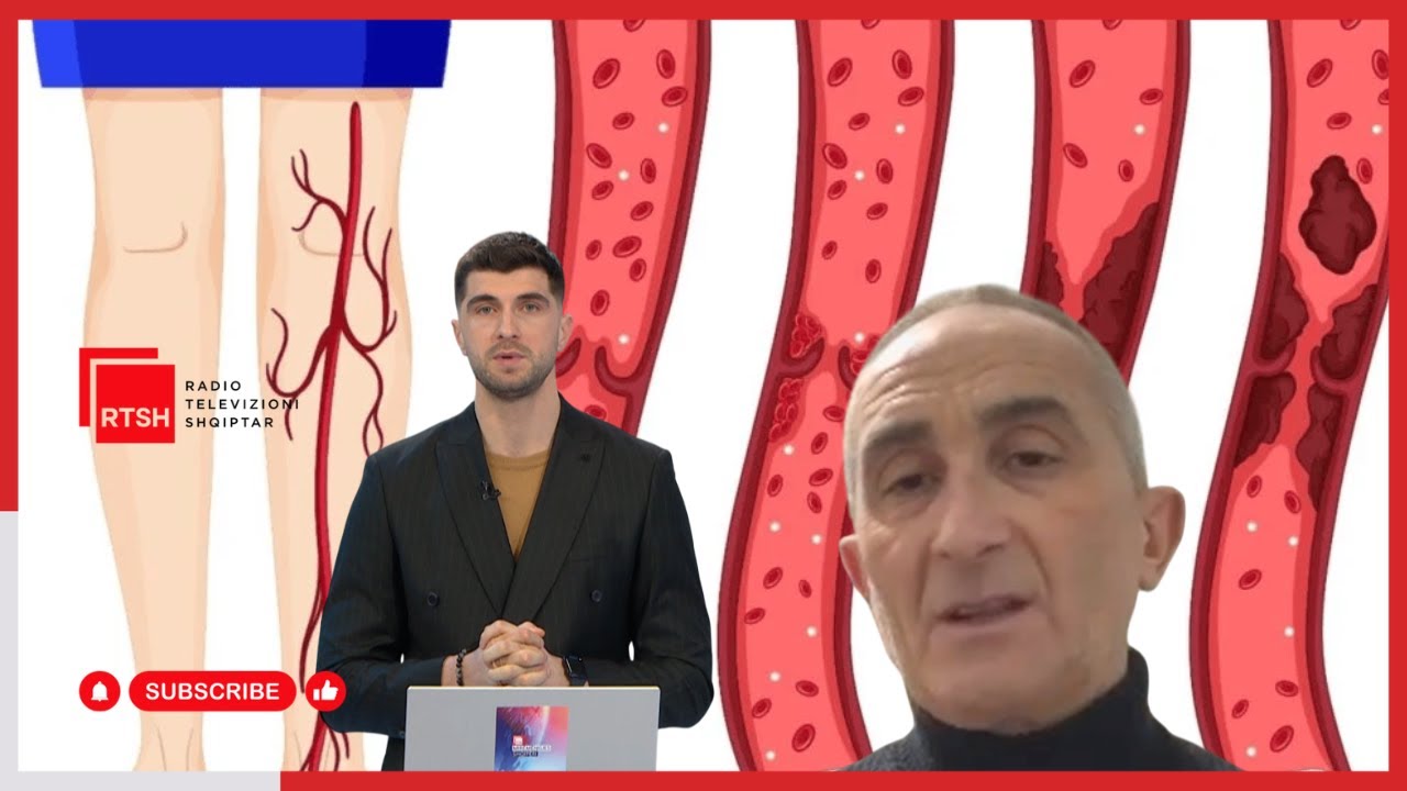 Trombozat, si të shmangim këto surpriza vdekjeprurëse | Mirëmëngjes Shqipëri