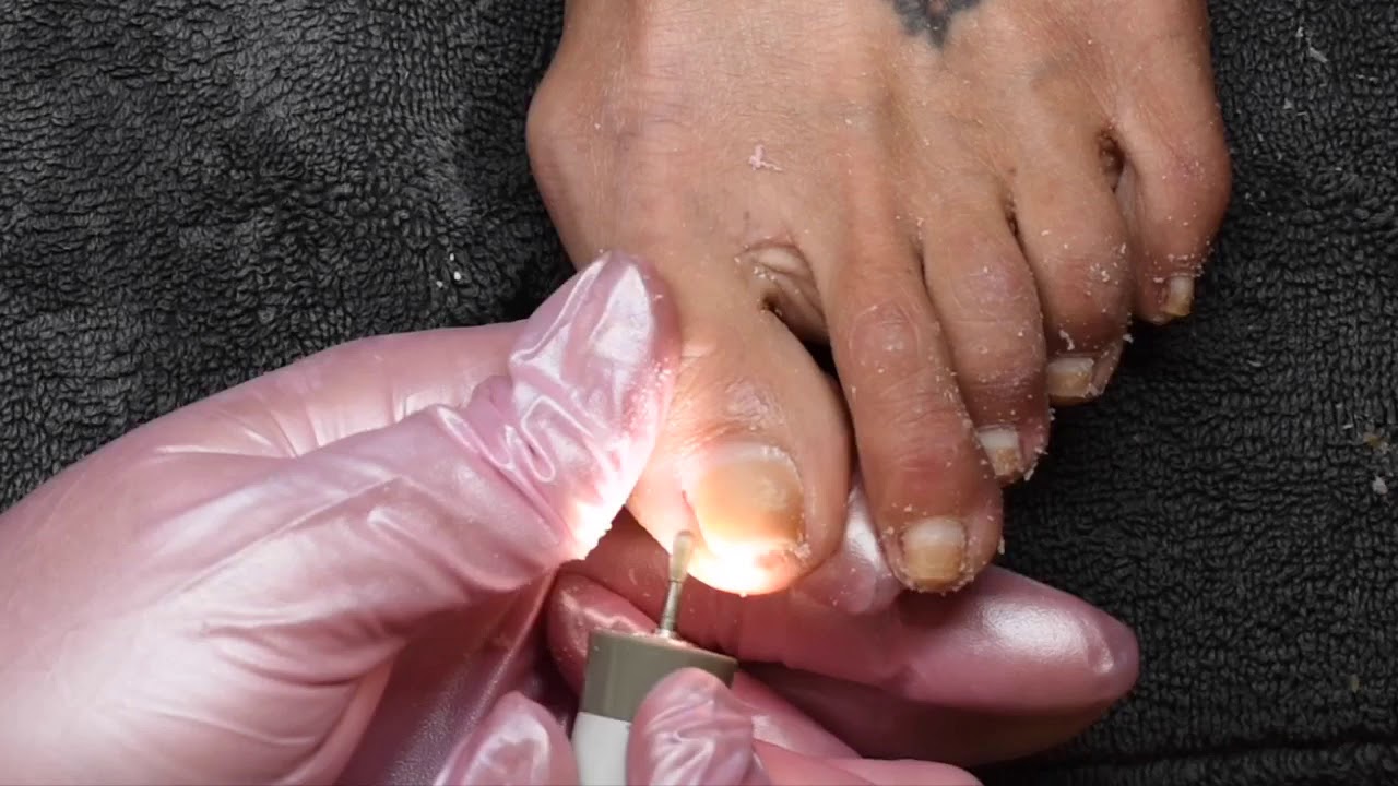 Involuted toenails with excessive build up