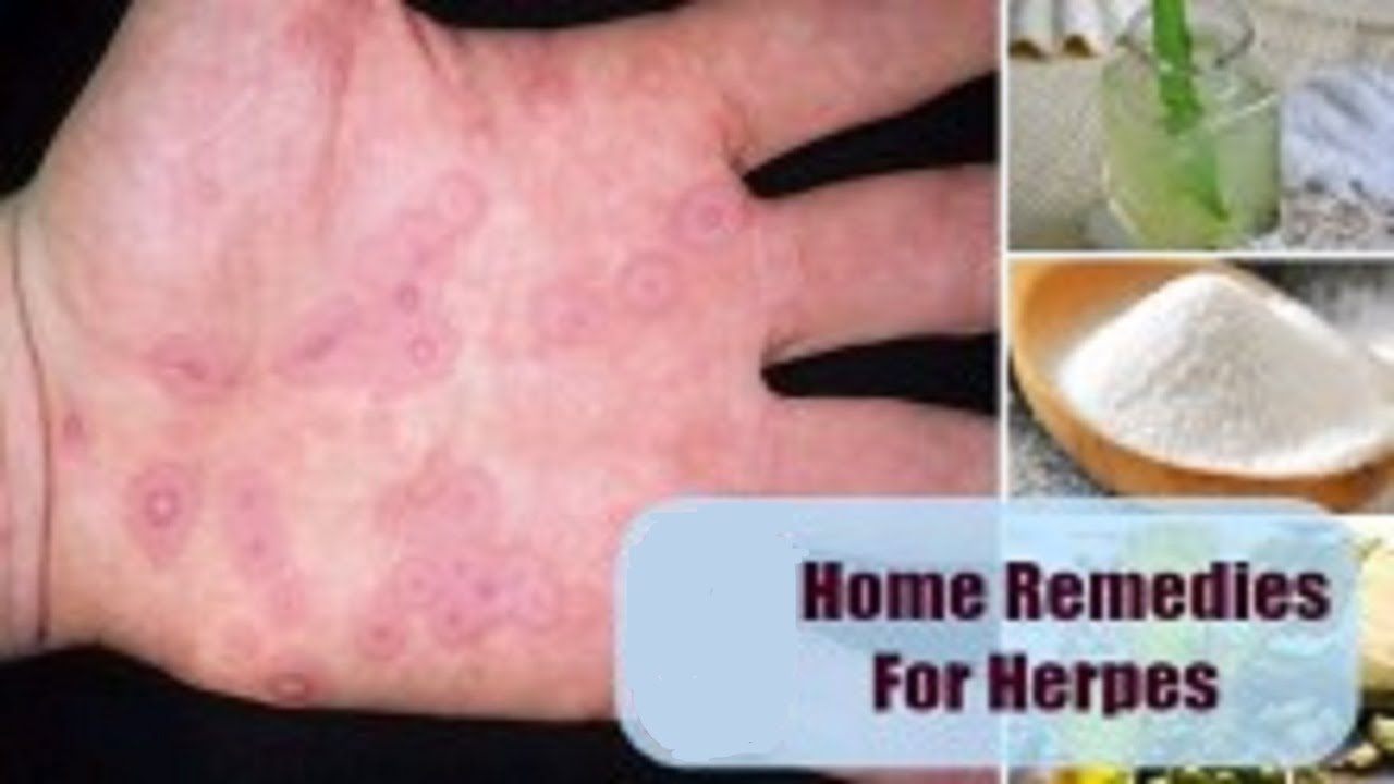 Incredible Home remedies for Herpes | HSV | HealthCare.