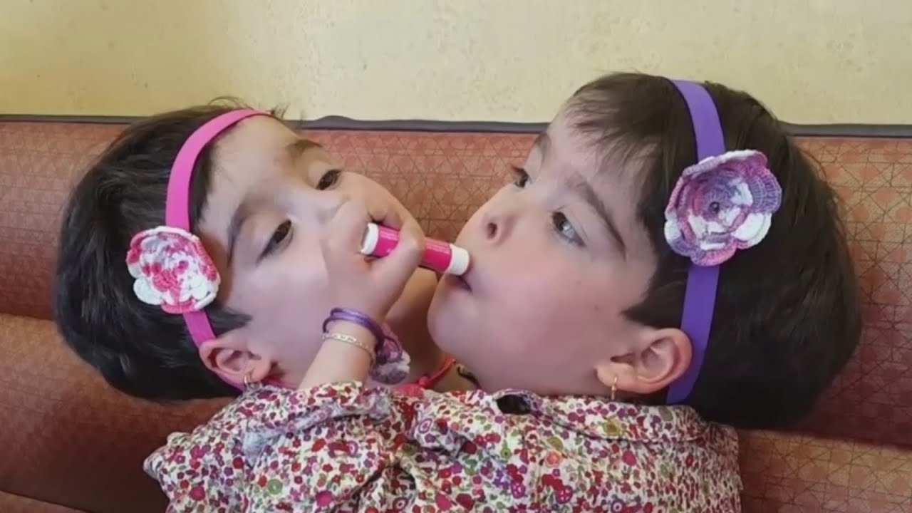 Siamesas podrían ser separadas