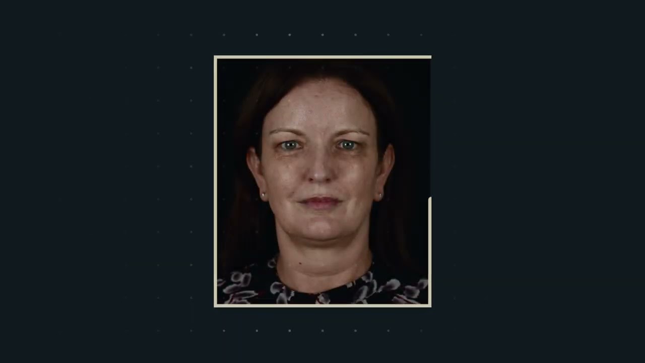A Patient’s Journey Through BBL Treatment | McKeown Medical