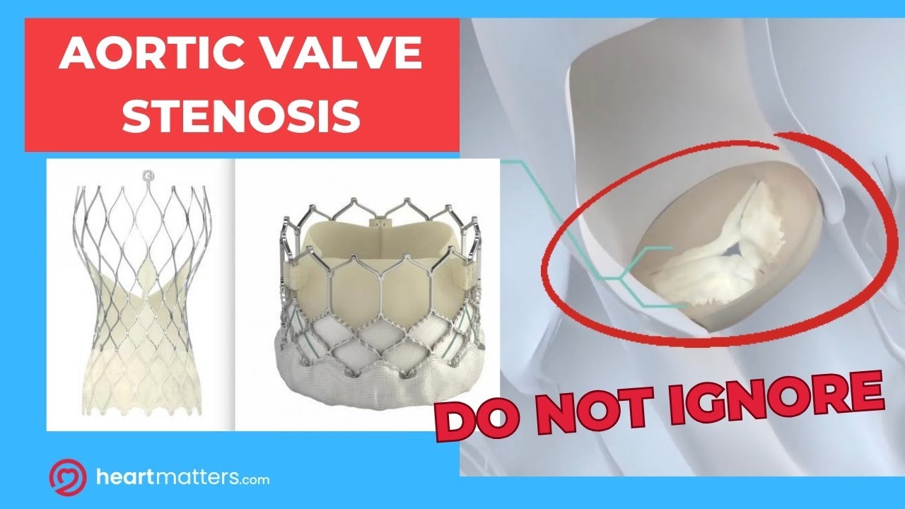 What is Aortic Stenosis? A Focus on Causes, Symptoms and Management.