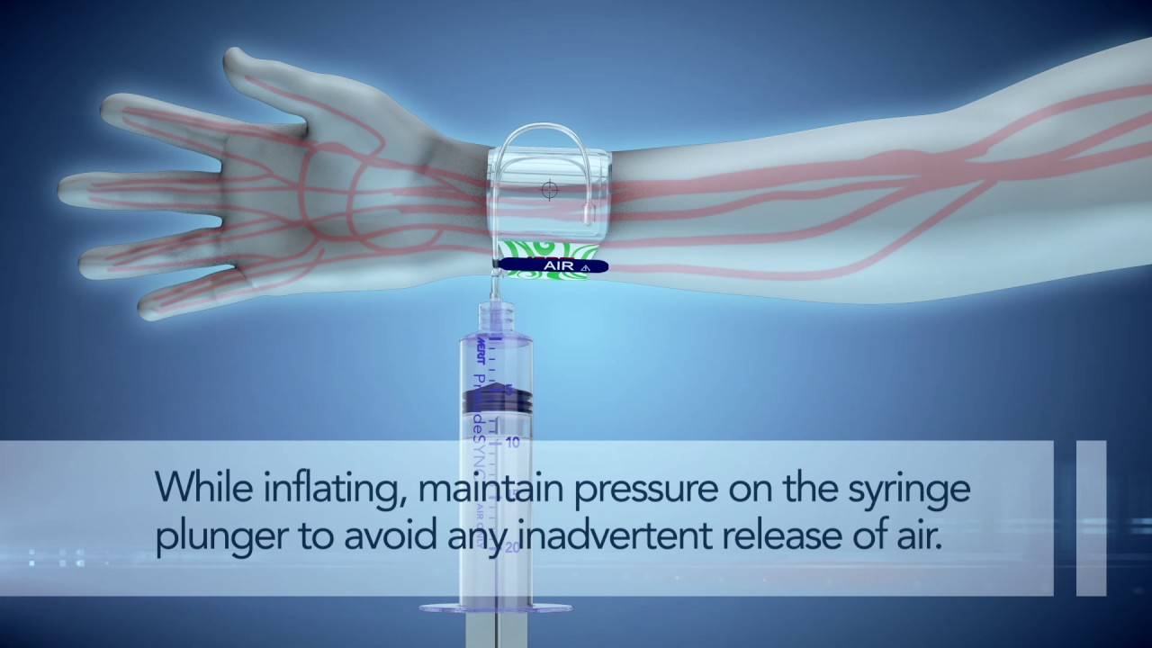 PreludeSYNC&trade; Radial Compression Device
