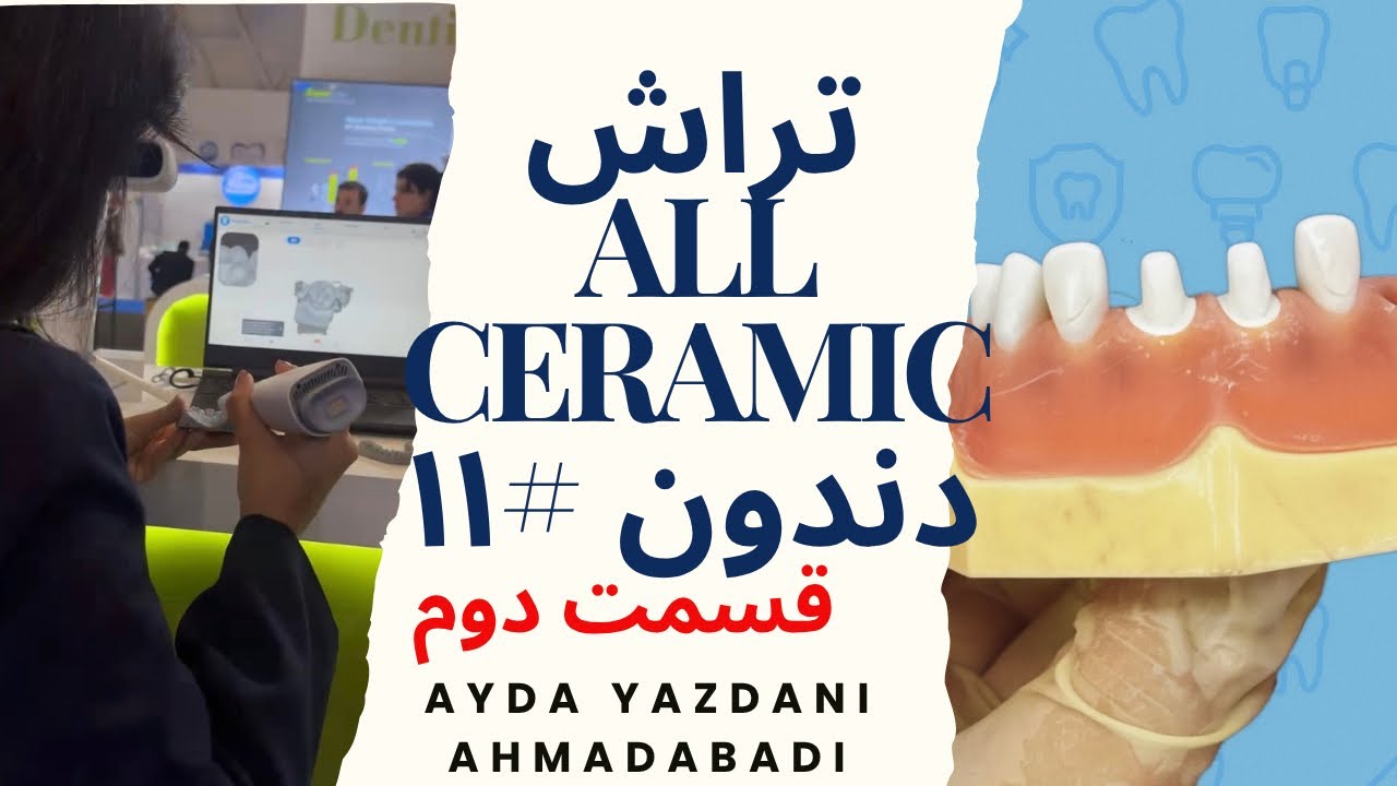 تراش دندان #۱۱ برای روکش تمام سرامیک مخصوص دانشجویان دندانپزشکی🦷(قسمت دوم)
