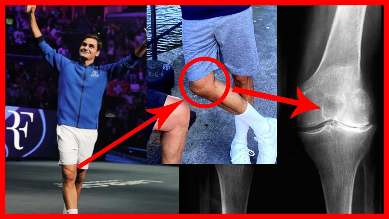 LA LESION que retiró a ROGER FEDERER