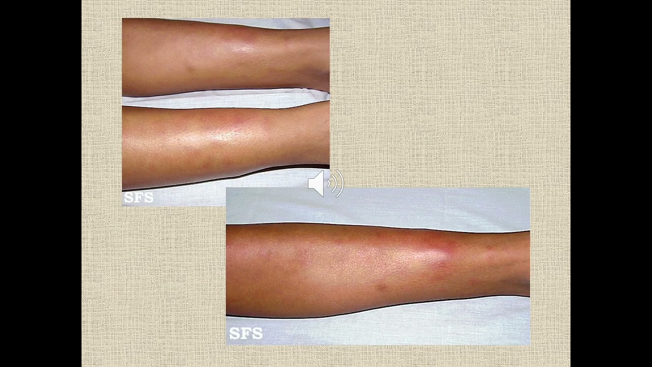 Dermatología, MEDUVSF 2025: Paniculitis
