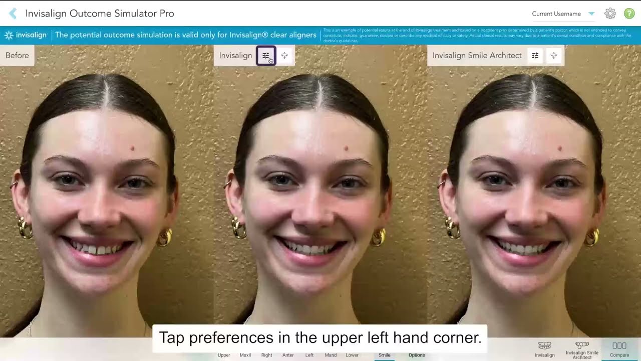 Invisalign&reg; Outcome Simulator Pro setting preferences  IPP, IPR & AP corrections