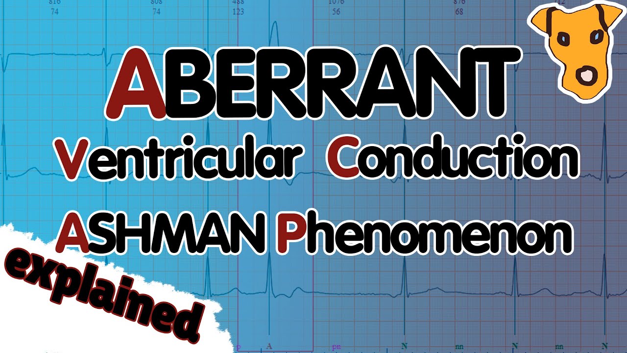 ABERRANT VENTRICULAR CONDUCTION. Ashman Phenomenon. Explained.