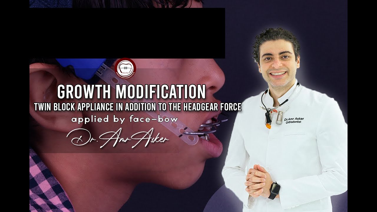 Growth Modification By Twin Block & Headgear