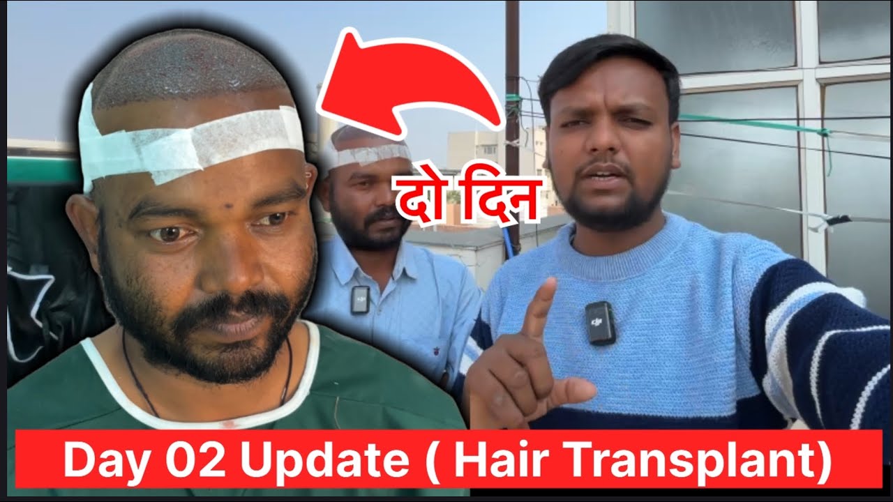 Day 02 Hair Transplant Surgery || Patient Experience 