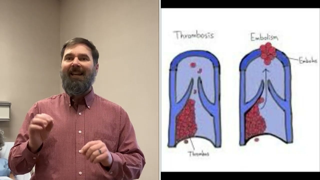 Thromboembolism