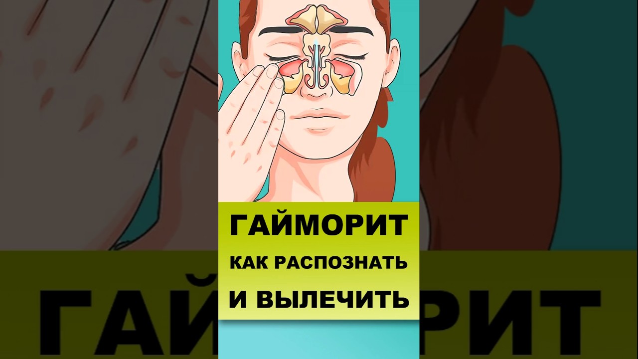 ГАЙМОРИТ И СИНУСИТЫ. Как помочь себе? #гайморит #синусит #лечениегайморита