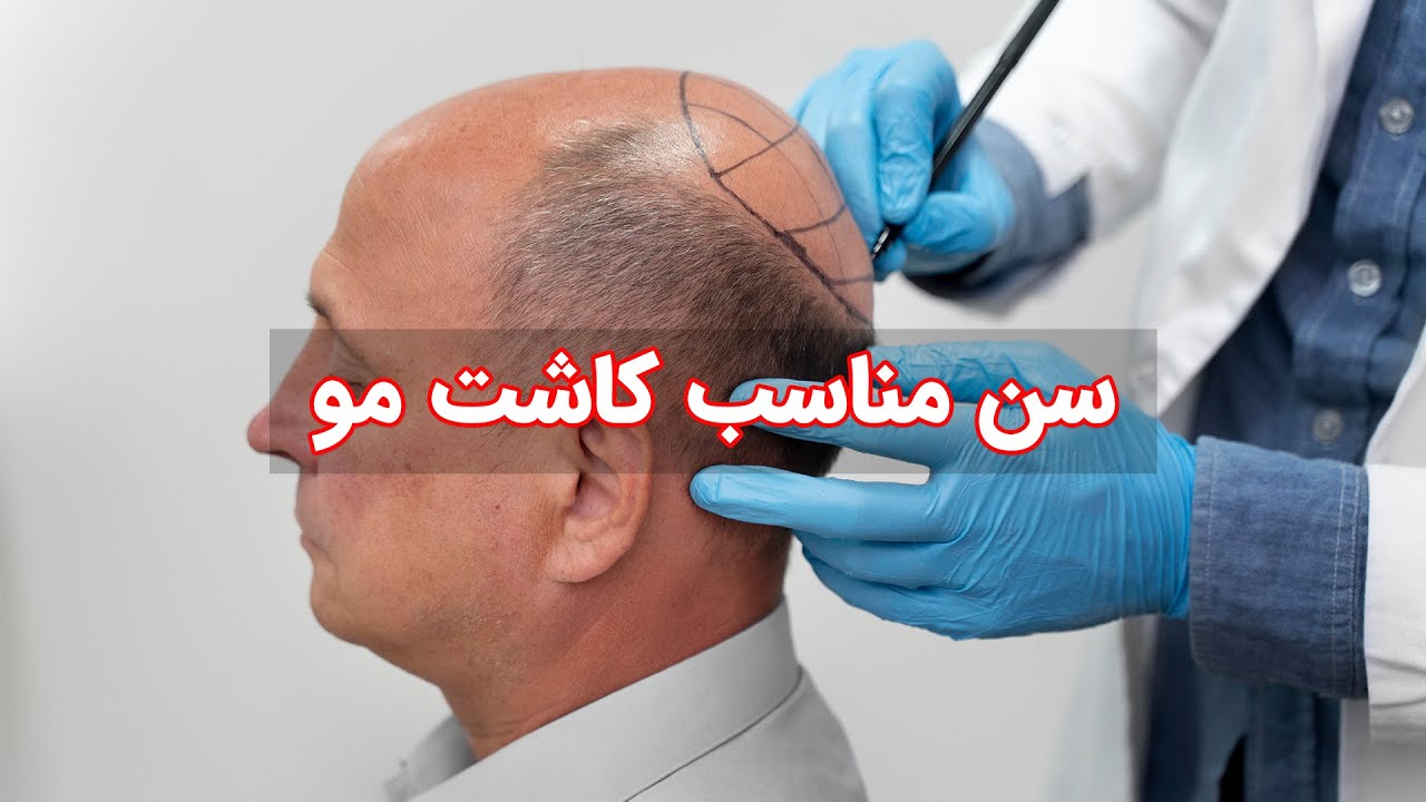 بهترین سن کاشت مو برای آقایان