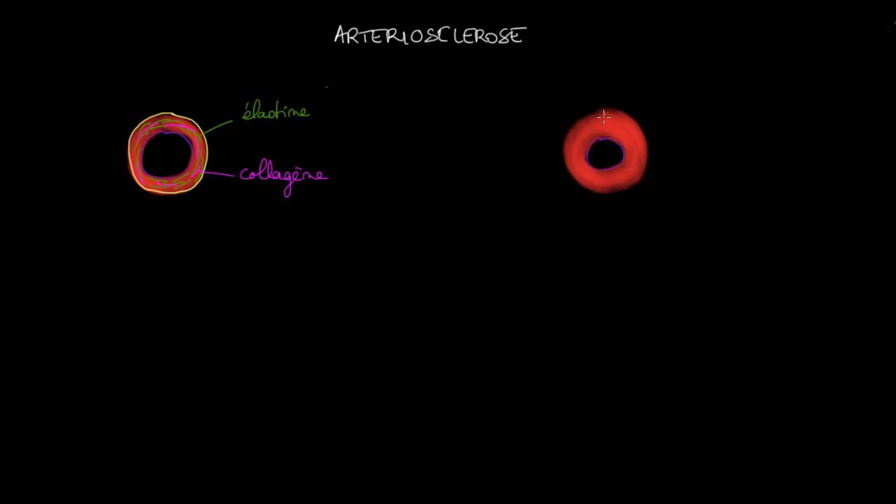Arteriosclerose et atherosclerose