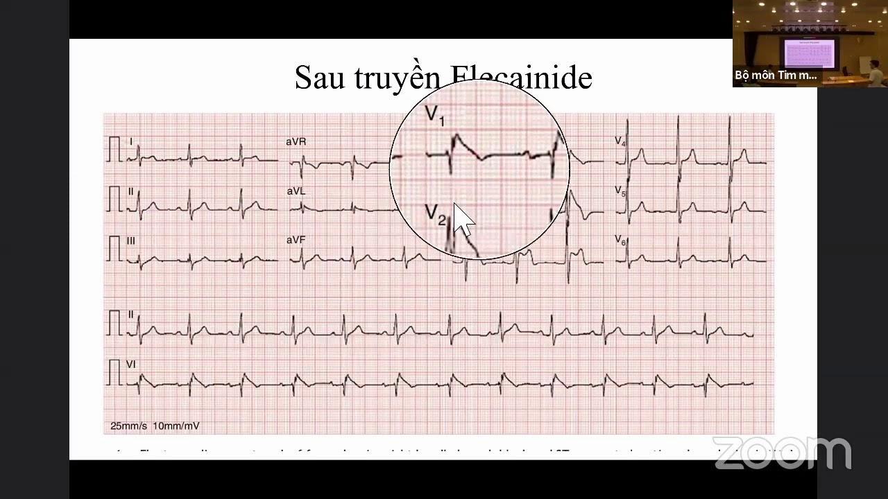 Điện tâm đồ (ngày 8): Phân tích ĐTĐ trong rối loạn nhịp bẩm sinh