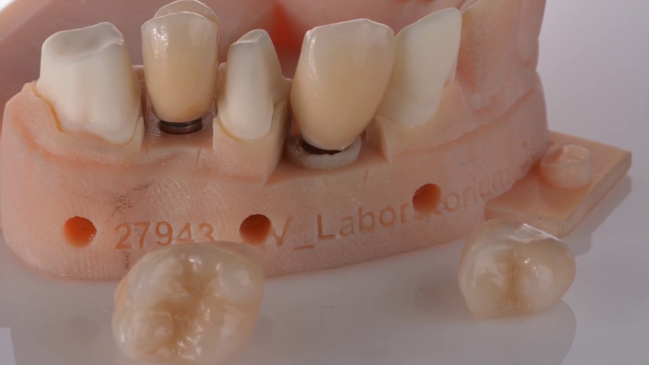 Implant & crown intraoral scan Carestream CS3600 Core 3D scanbody