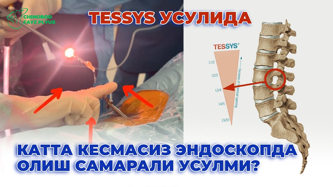 Бел грижадан 1 кунда халос бўлиш ҳақиқатми? 95- 070 -22- 94