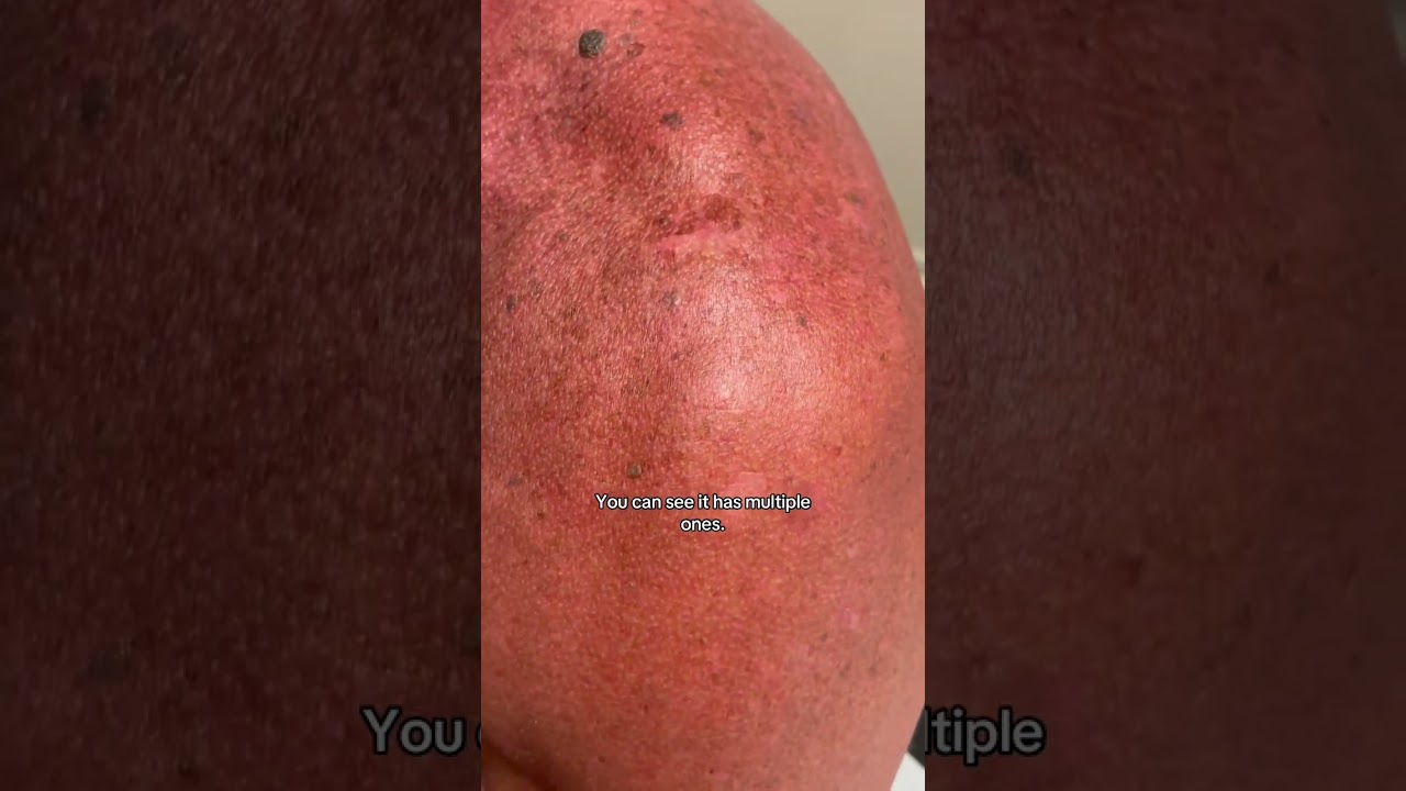 Dermatologist with 50+ Years of Experience Shows Different Mole Types on Patient's Skin
