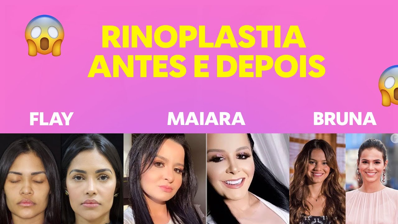 RINOPLASTIA ANTES E DEPOIS