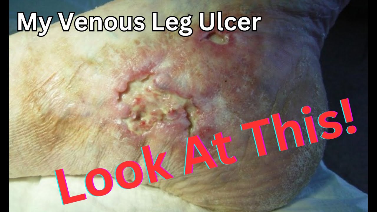 How I healed my leg Ulcers My Story
