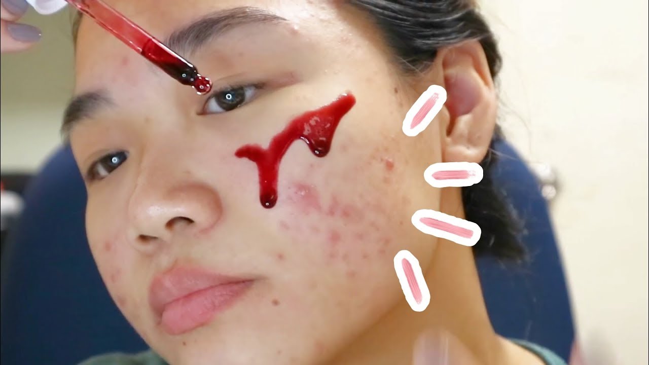 The ordinary peeling solution review (4 weeks)