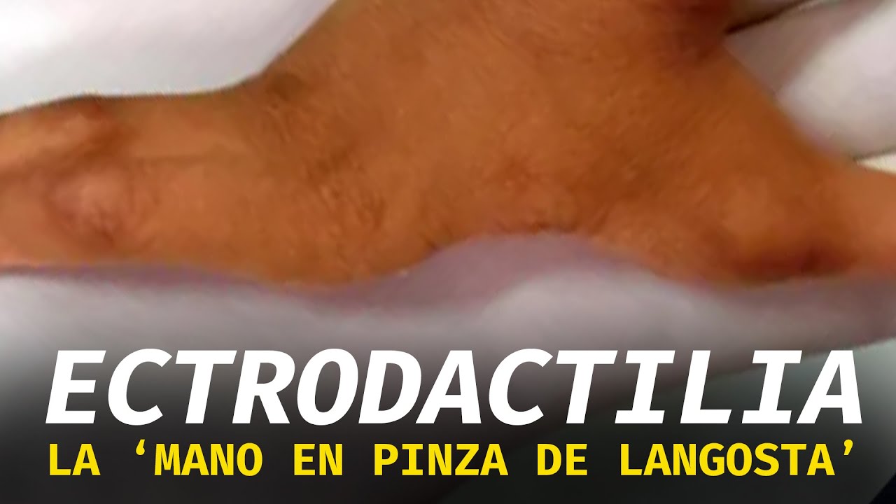 La ectrodactilia: la mano en pinza de langosta