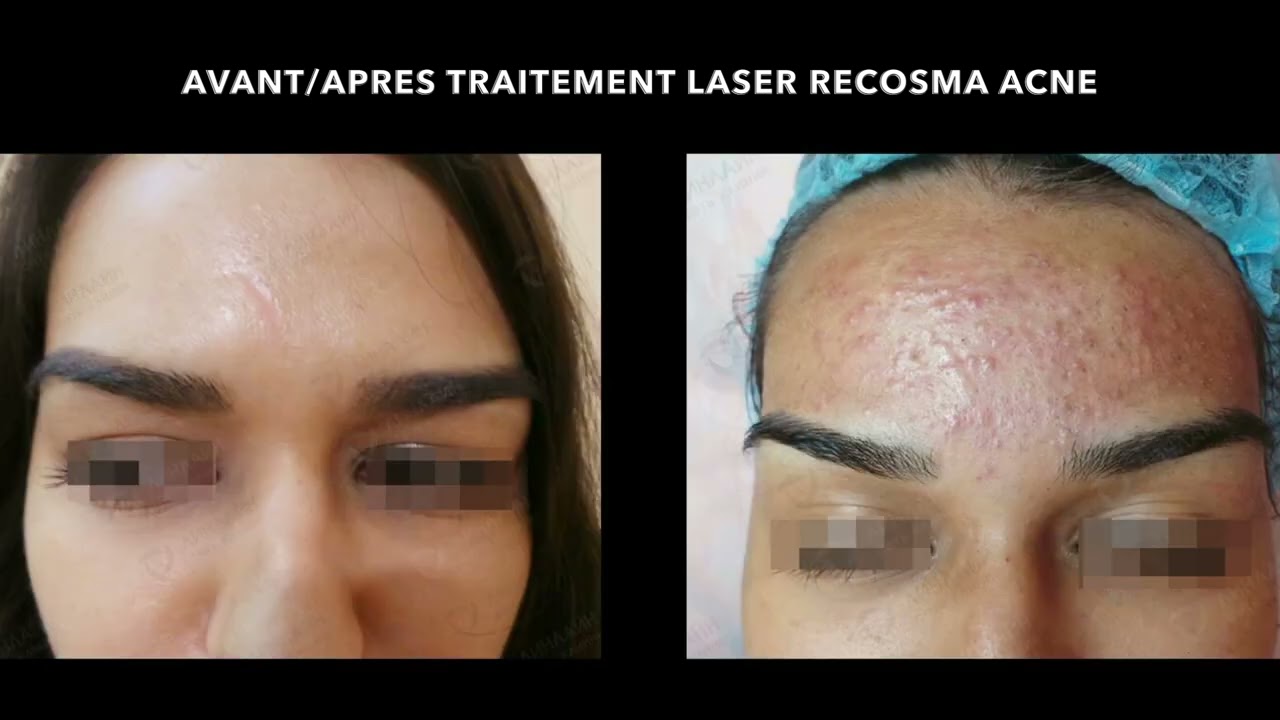Traitement laser breveté acné et cicatrice d'acné