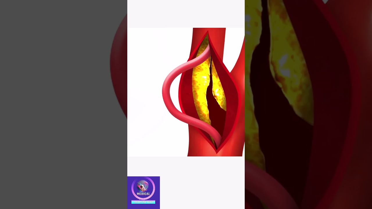 Carotid Artery Surgery - Endarterectomy Procedure