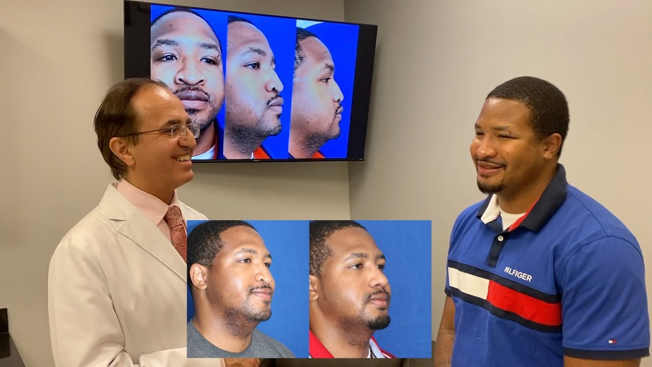 An Amazing Ethnic Rhinoplasty -- African American Rhinoplasty!