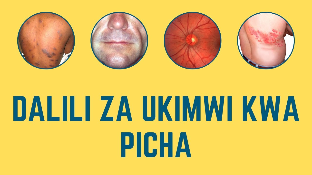 🚨ATTENTION!!🚨 Zifahamu Dalili za UKIMWI kwa kuangalia picha