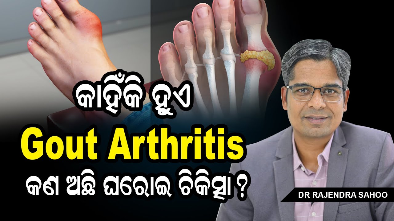 How to Treat Gout at Home: Diet, Remedies & Lifestyle Tips | @neuronpainclinic