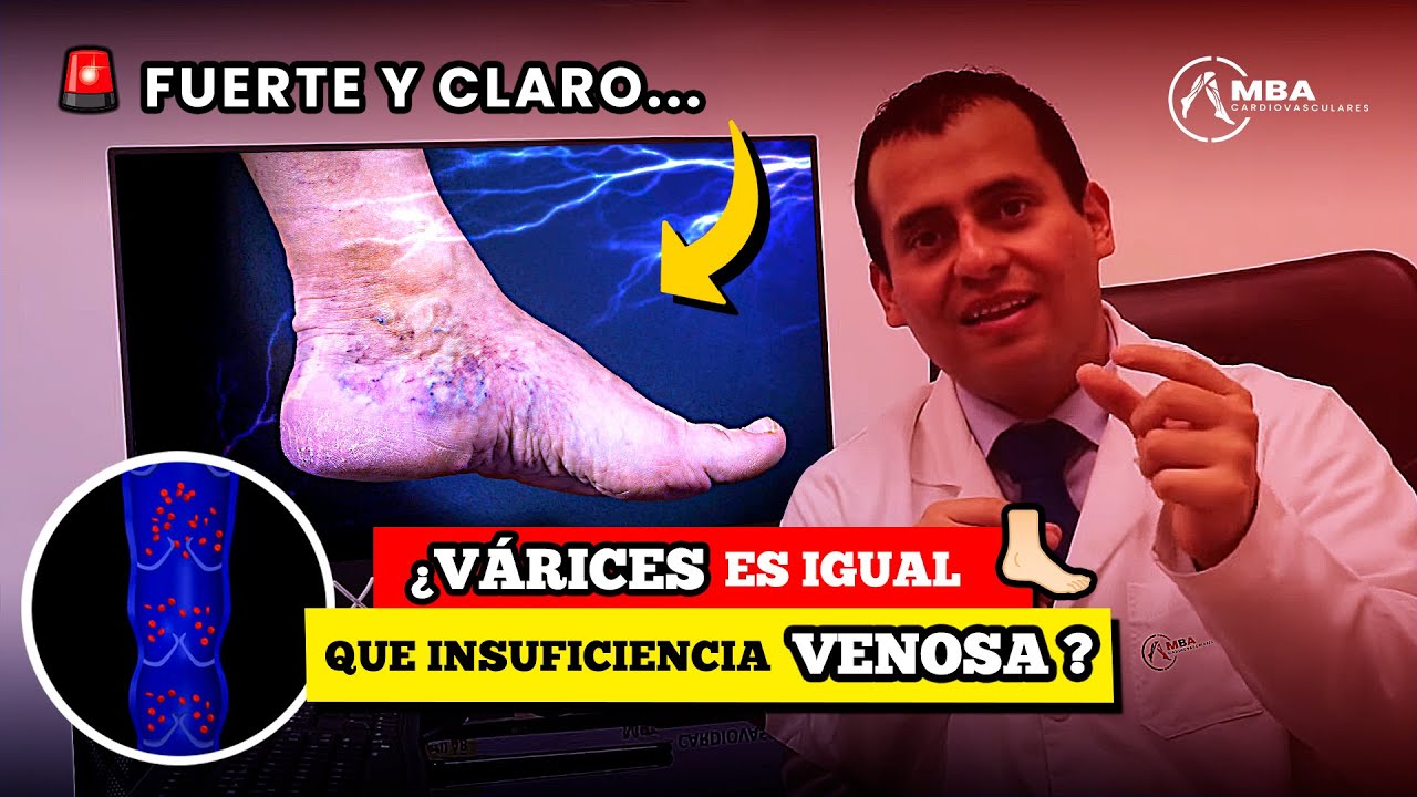 ¿Várices es igual que insuficiencia venosa crónica? - Dr.Manolo Briceño MBACARDIOVASCULARES