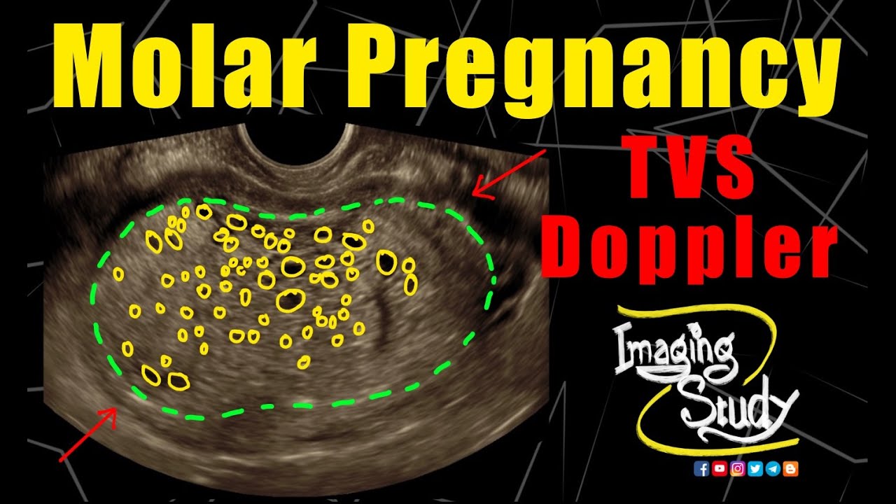 Molar Pregnancy || Hydatidiform Mole || TVS || Doppler || Ultrasound || Case 265