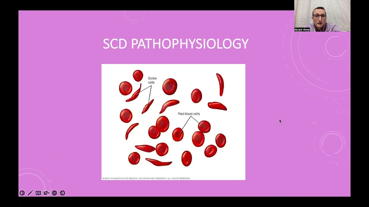 Anesthesia for pediatric patients with Sickle cell disease (SCD) & hemophilia, Part-1