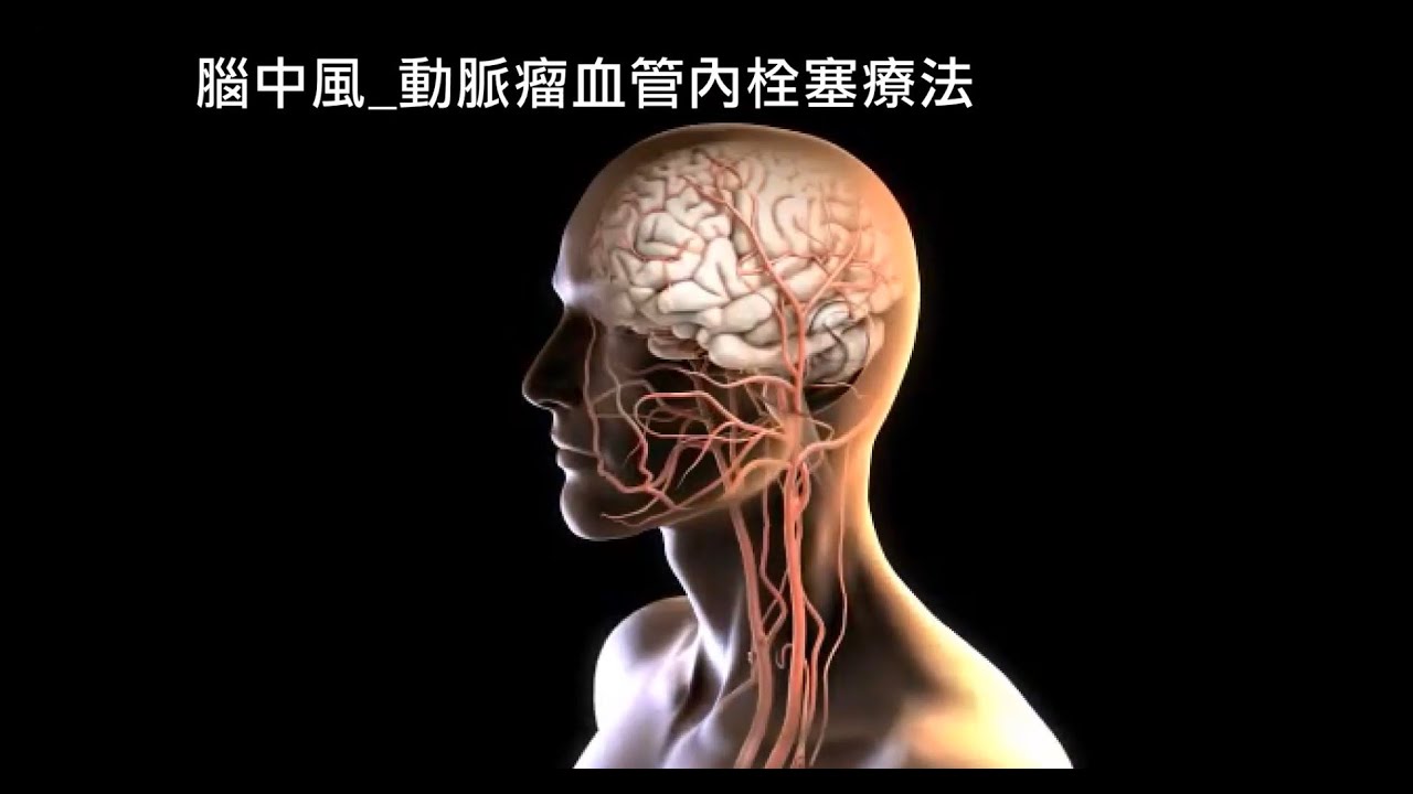 腦中風治療-動脈瘤血管內栓塞療法與顱內動脈取栓術