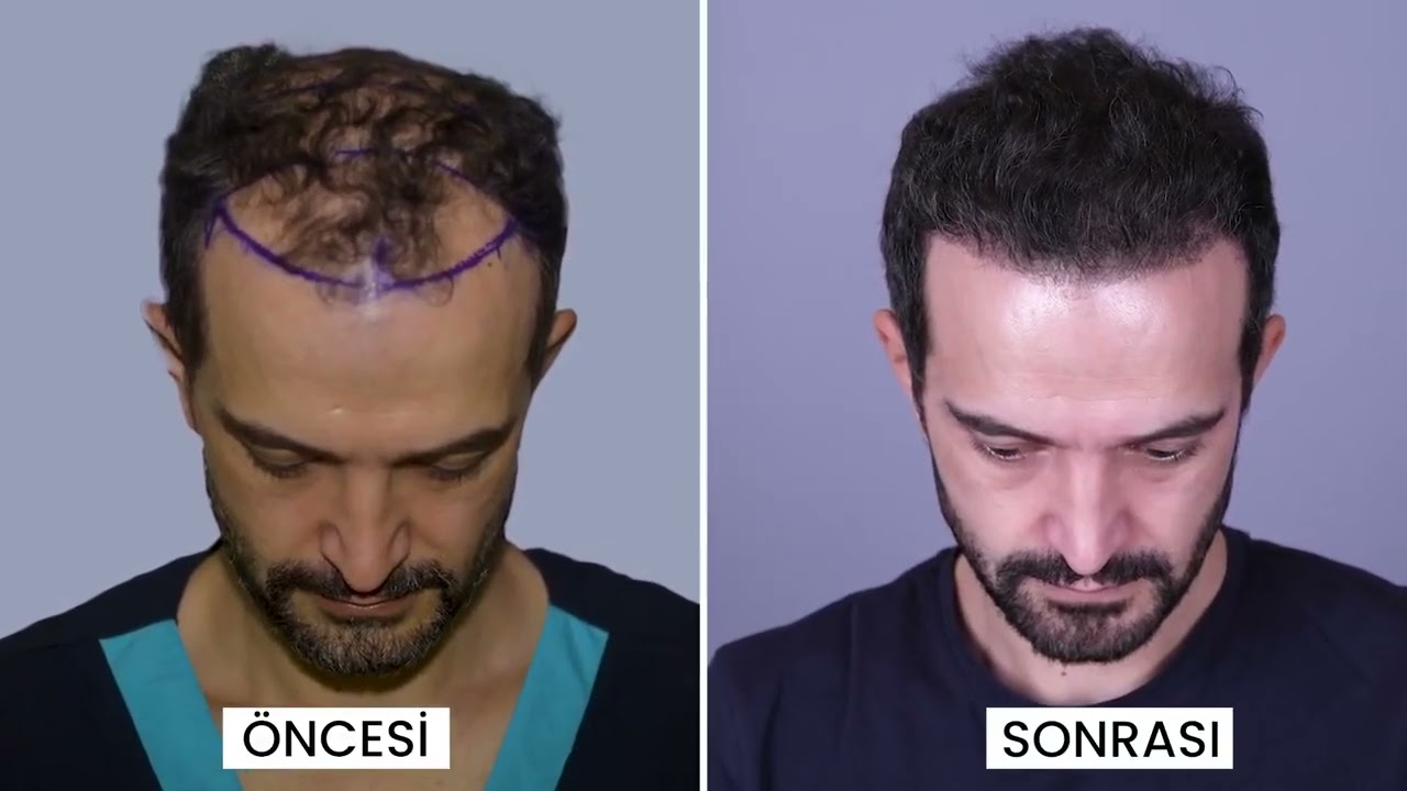 Smile Hair Clinic | Hair Transplant In Turkey