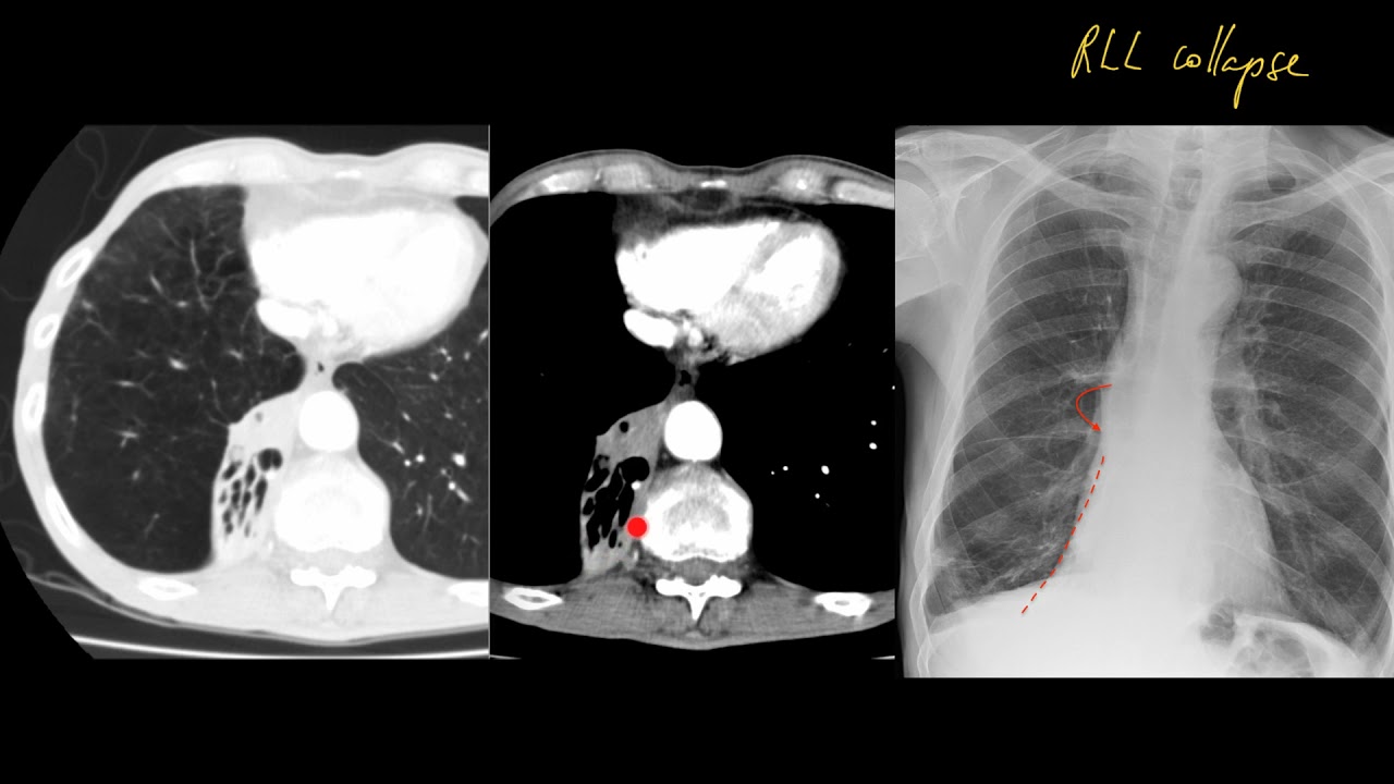 That chest x-ray looks normal, why is it in my exam? How to approach the unremarkable one