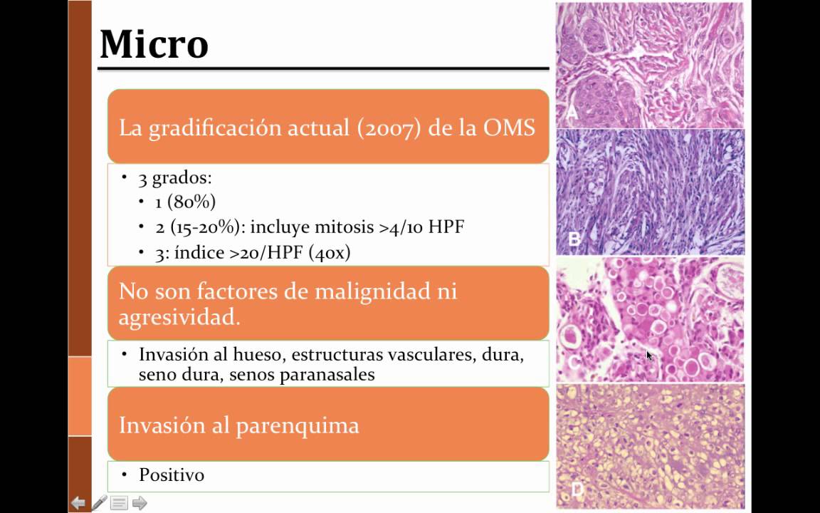 Meningiomas