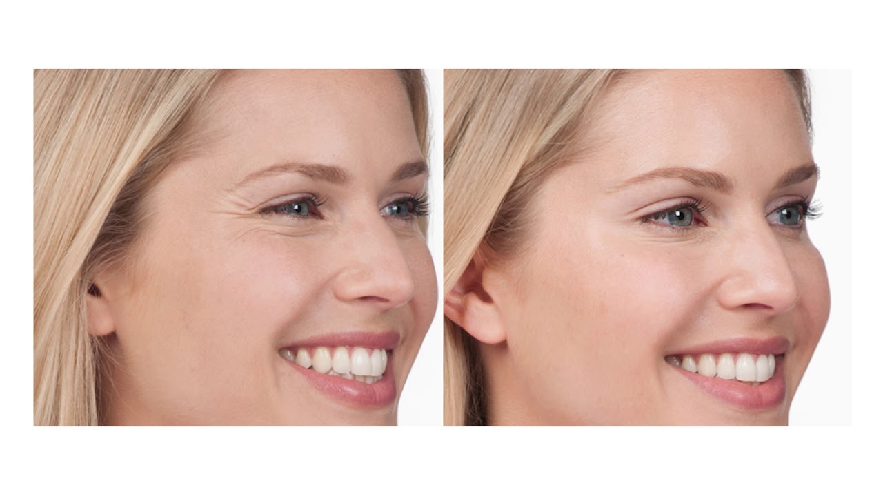 BOTOX&reg; & Dysport&reg; | Stoker Plastic Surgery