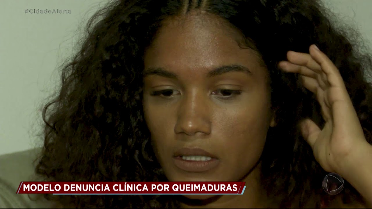 Modelo denuncia clínica de estética por queimaduras