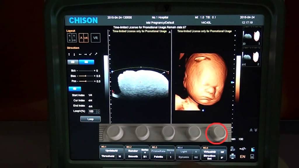 CHISON 4D Training  Video