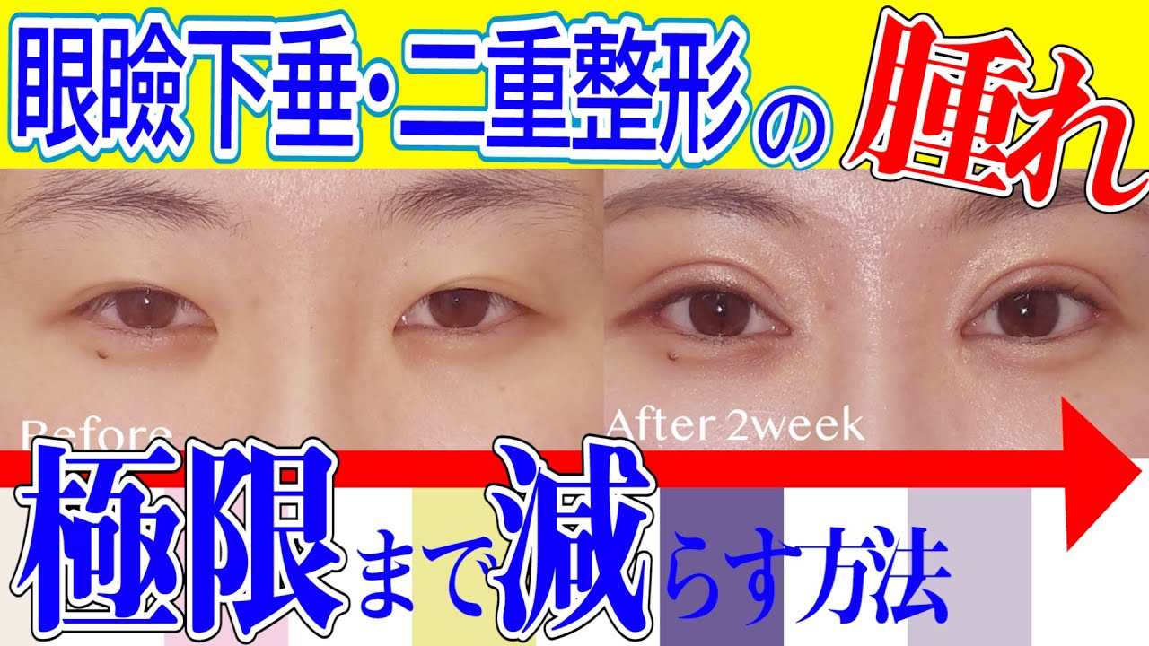 二重・眼瞼下垂整形の腫れを減らす方法を医師が解説【湘南美容クリニック眼瞼下垂・眉下切開・目の下のタルミ取りもOK】