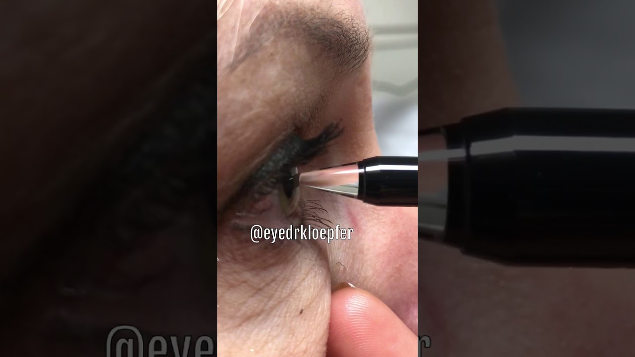 Pachymetry : real time and slow mo!