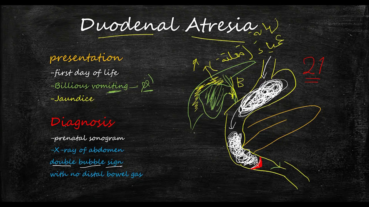 Duodenal atresia محاضرة في الاطفال وشرح للتشخيص والعلاج