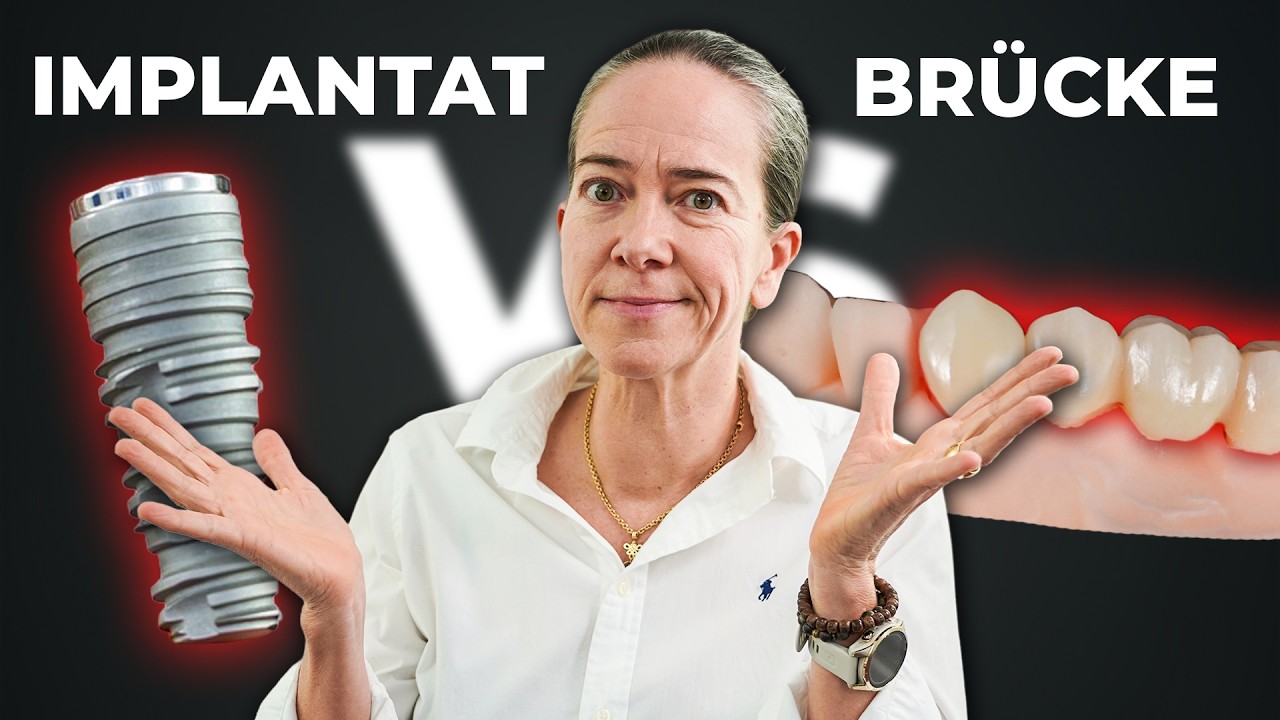 DAS solltest du vorher wissen: Brücke vs Implantat