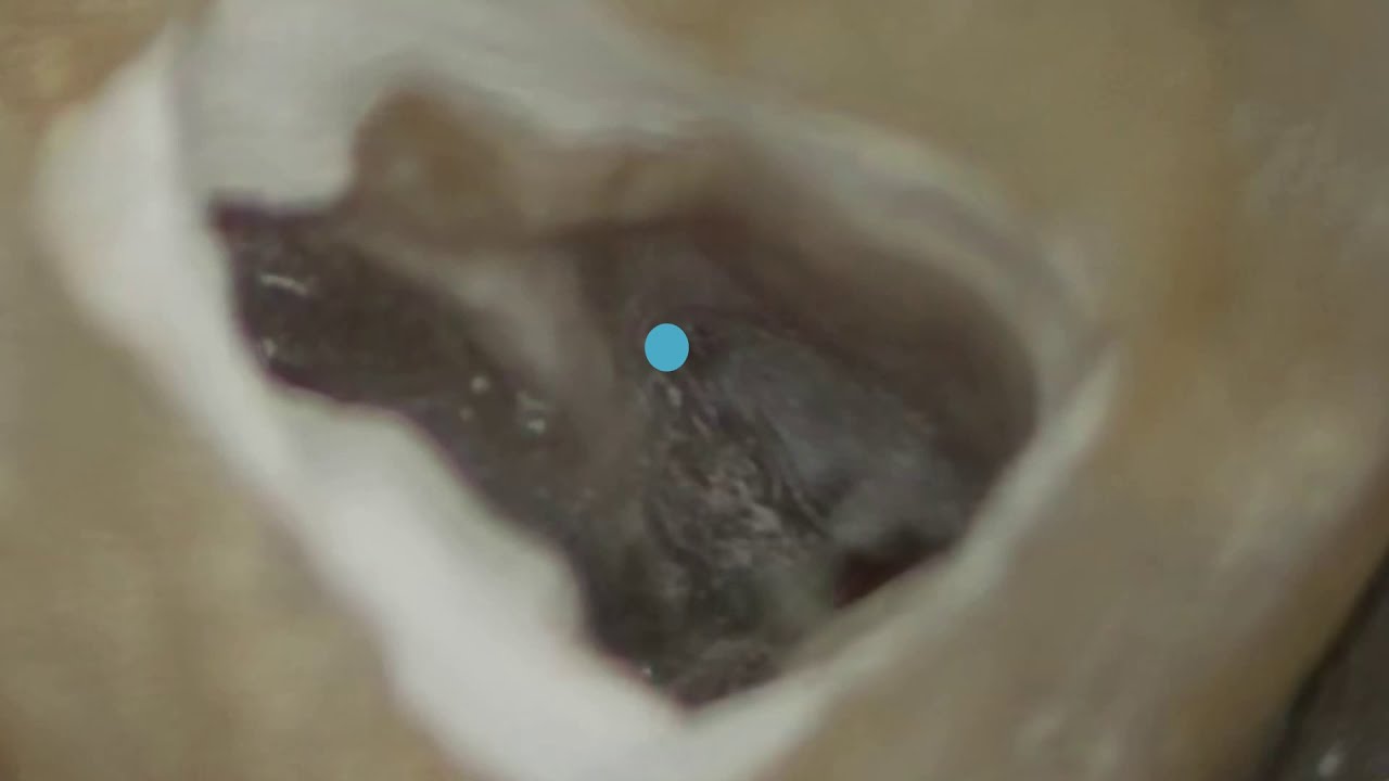 Finding MB2 canal in maxillary first molar
