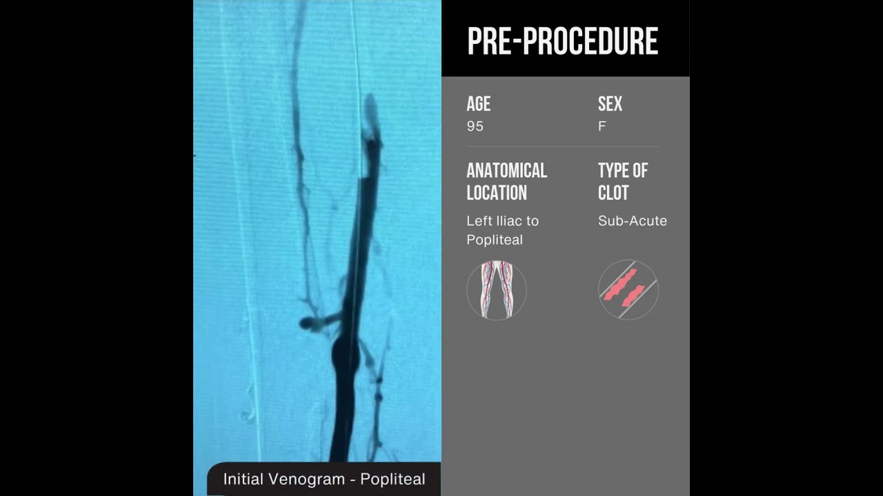 Venous Thrombosis of Left Lower Extremity