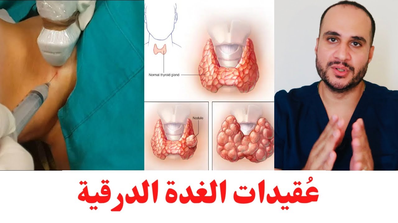 ٤- عُقيدات الغدة الدرقية.. اهم ما يجب ان تعرفه عنها ؟؟