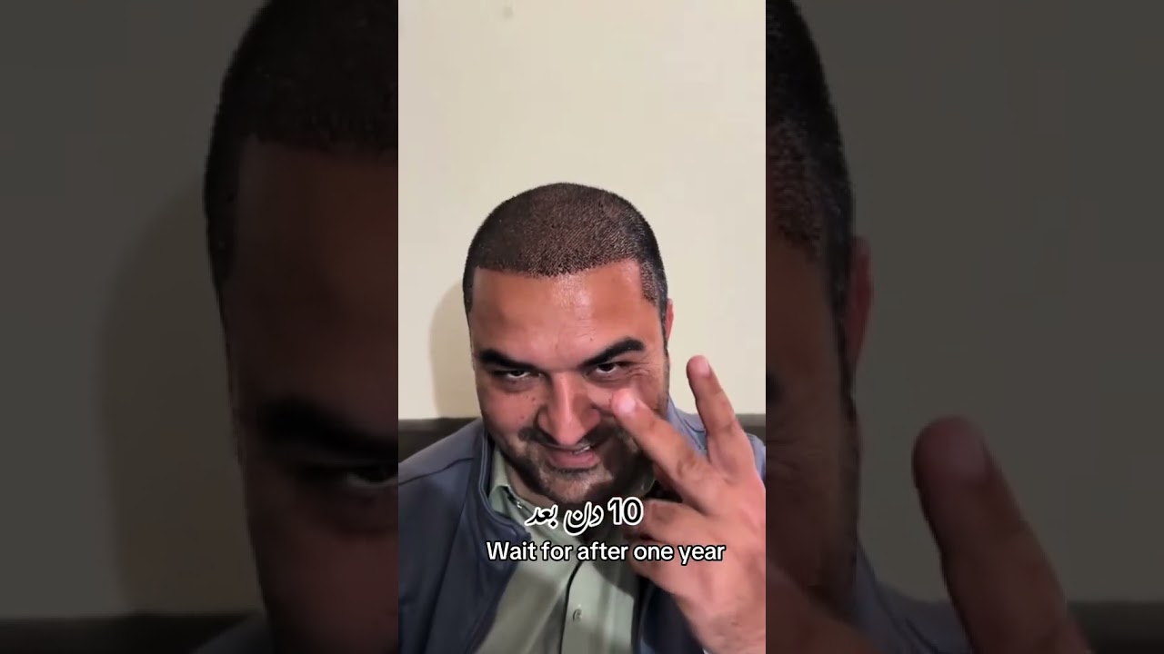 Hair transplant 1 year Result 