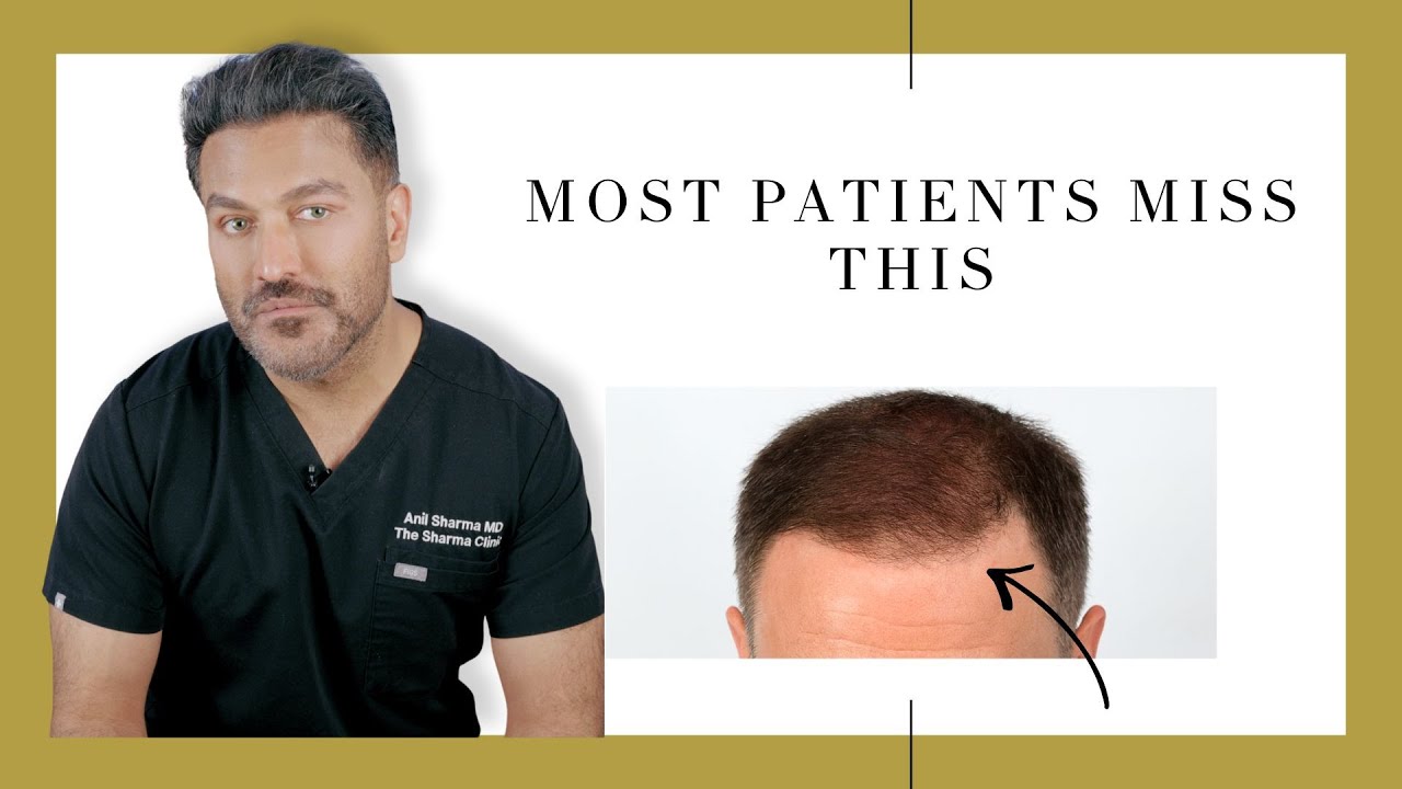5 Things That Actually Determine Your Hair Transplant Results (Surgeon’s Perspective)